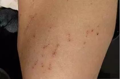 补硒降低血沉（补降低硒血沉的中药）-硒宝网