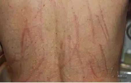 补硒降低血沉（补降低硒血沉的中药）-硒宝网