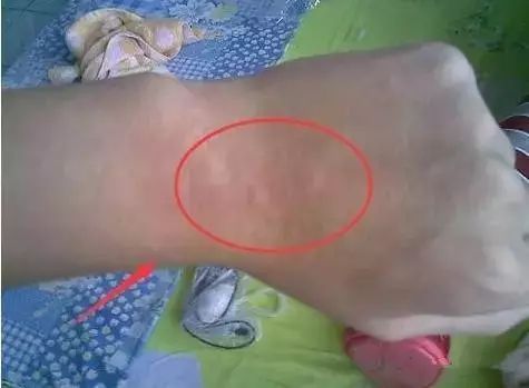 补硒降低血沉（补降低硒血沉的中药）-硒宝网