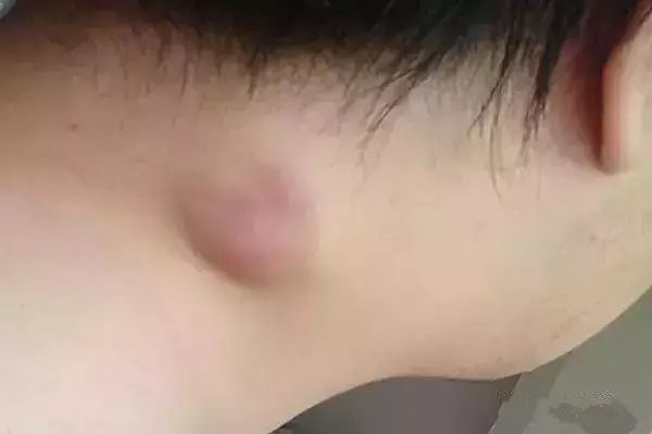 补硒降低血沉（补降低硒血沉的中药）-硒宝网