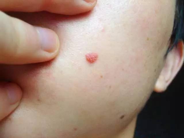 补硒降低血沉（补降低硒血沉的中药）-硒宝网