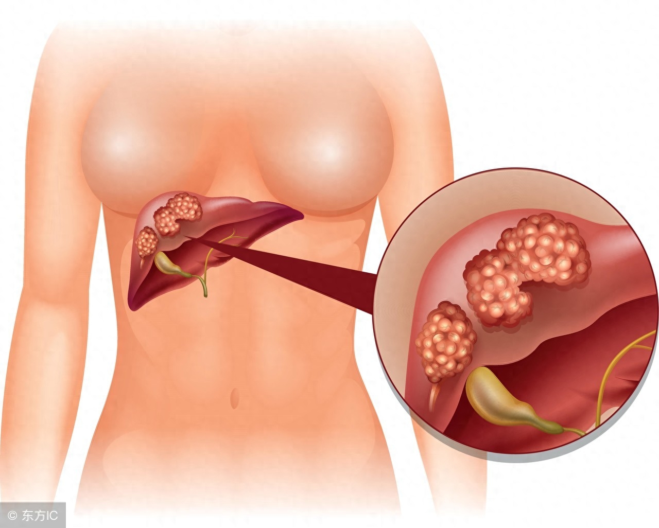 补硒减少肝癌(肝癌补硒多长时间能恢复肝功能)-硒宝网
