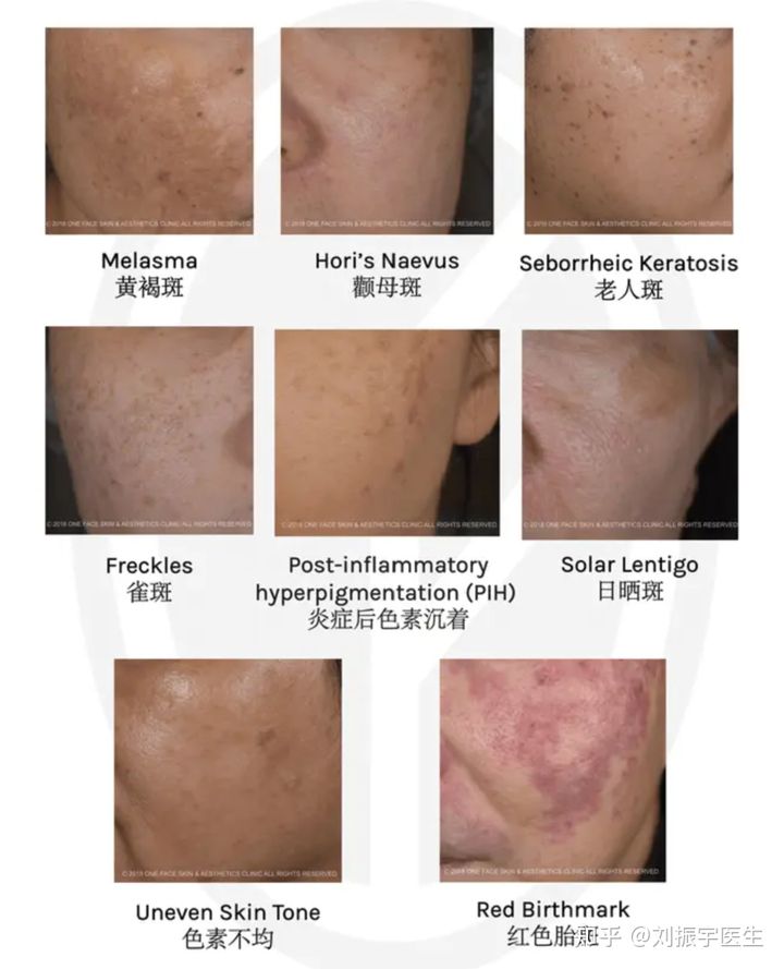 补硒对白癜风（补硒能治疗乙肝吗）-硒宝网