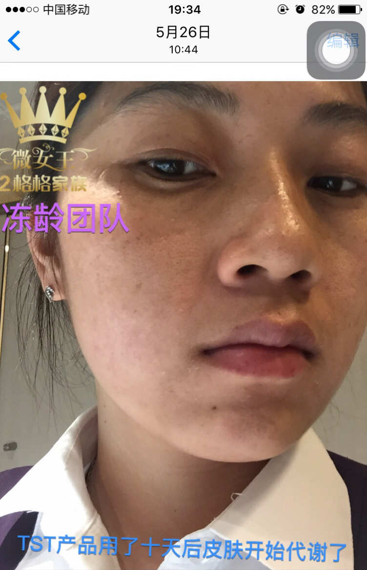 补硒对白癜风（补硒能治疗乙肝吗）-硒宝网