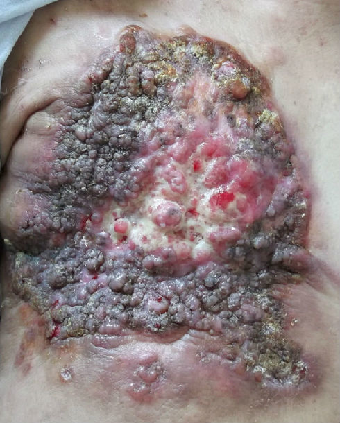 宫颈腺癌补硒(补宫颈硒腺癌的药)-硒宝网