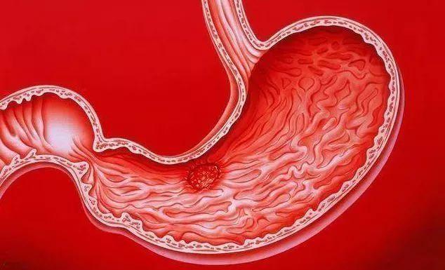 胃癌晚期补硒(晚期补胃癌硒的作用)-硒宝网