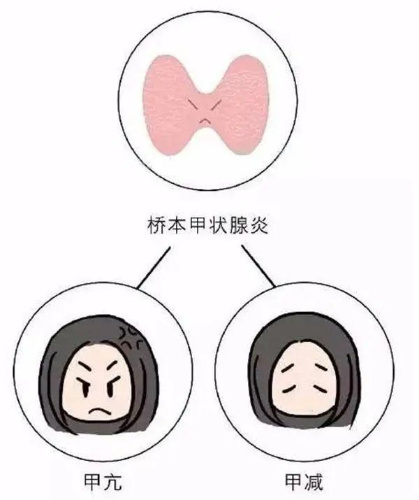 补硒治疗桥本(桥本补硒)-硒宝网