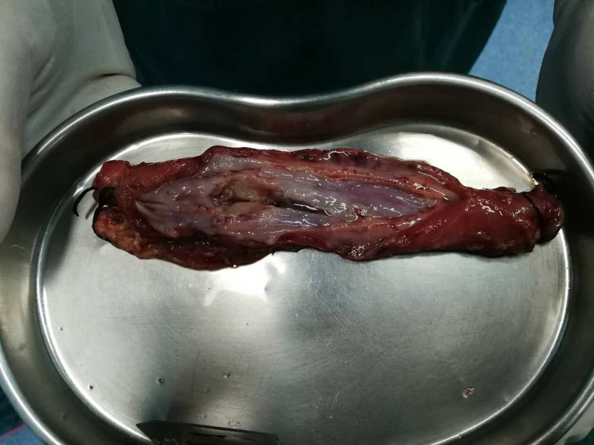 活检病变补硒（低度病变活检几种结果）-硒宝网