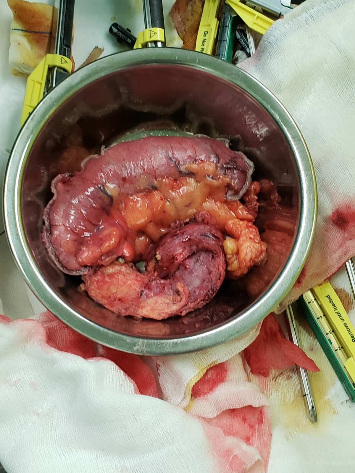 活检病变补硒（低度病变活检几种结果）-硒宝网