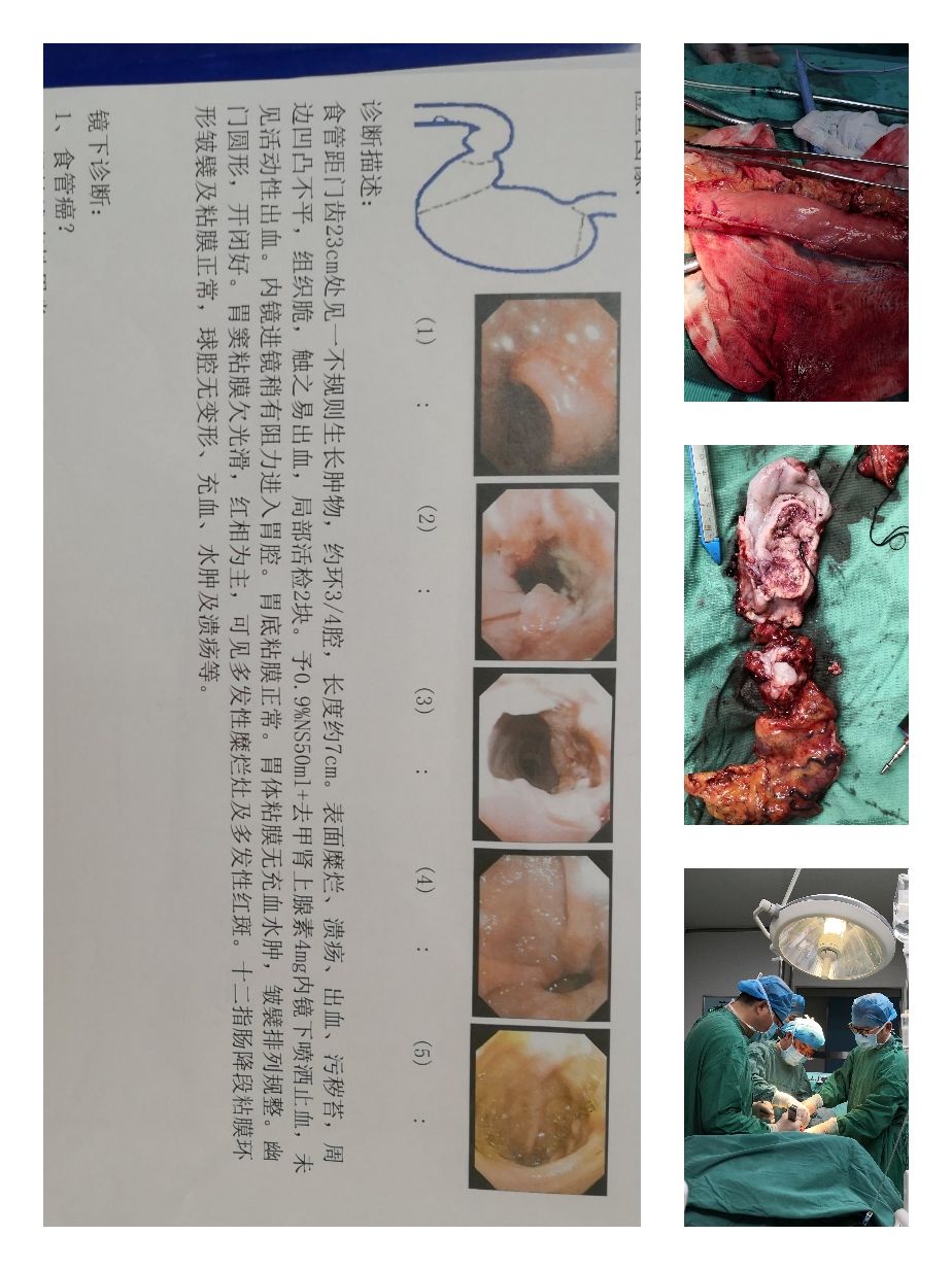 活检病变补硒（低度病变活检几种结果）-硒宝网