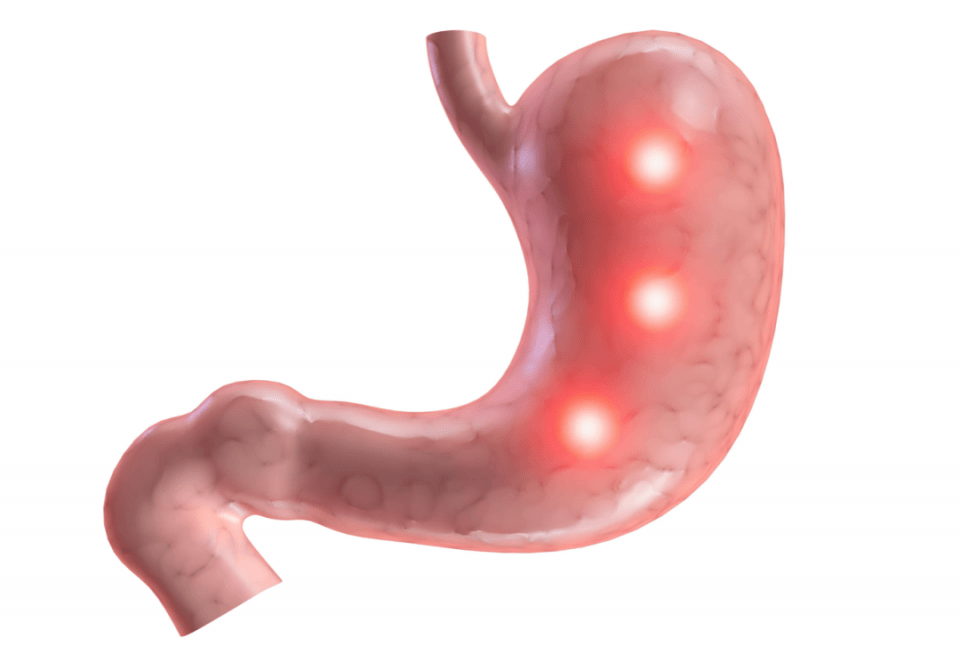 补硒过剩症状（补硒过剩症状）-硒宝网