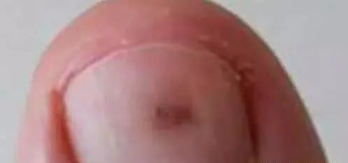 指甲发白补硒（指甲白要补充什么东西）-硒宝网