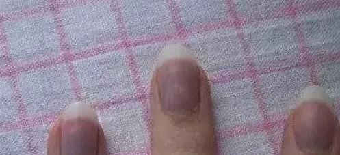 指甲发白补硒（指甲白要补充什么东西）-硒宝网