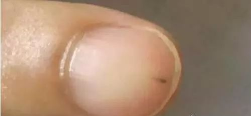 指甲发白补硒（指甲白要补充什么东西）-硒宝网