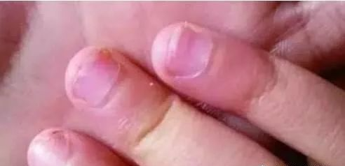 指甲发白补硒（指甲白要补充什么东西）-硒宝网