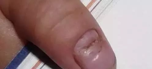 指甲发白补硒（指甲白要补充什么东西）-硒宝网