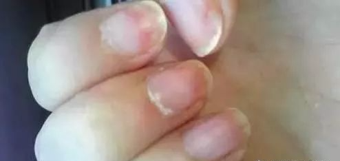 指甲发白补硒（指甲白要补充什么东西）-硒宝网