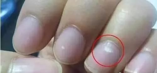 指甲发白补硒（指甲白要补充什么东西）-硒宝网