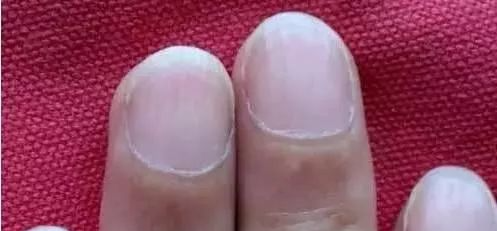 指甲发白补硒（指甲白要补充什么东西）-硒宝网