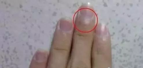 指甲发白补硒（指甲白要补充什么东西）-硒宝网
