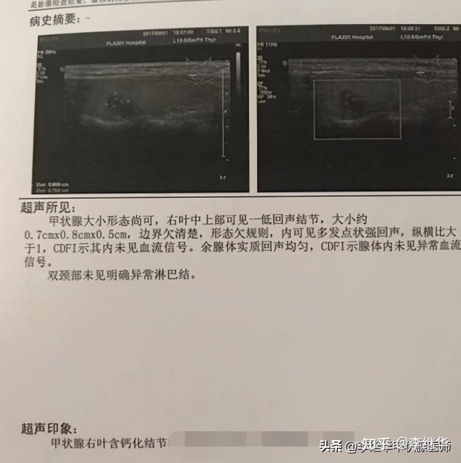 桥本结节补硒(桥本补硒吃什么)-硒宝网