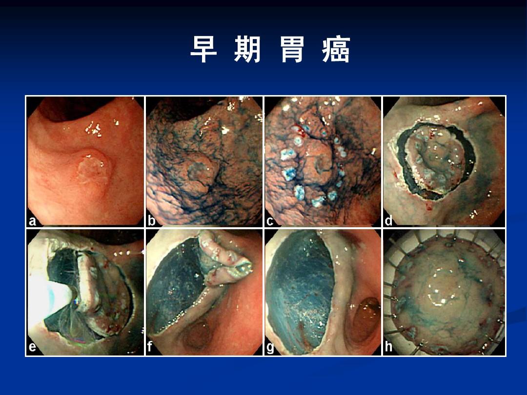 肺癌转移补硒(肺癌转移补硒)-硒宝网