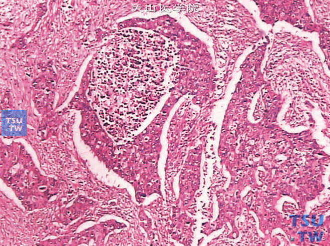 癌症补硒好吗(癌症补硒每天多少)-硒宝网