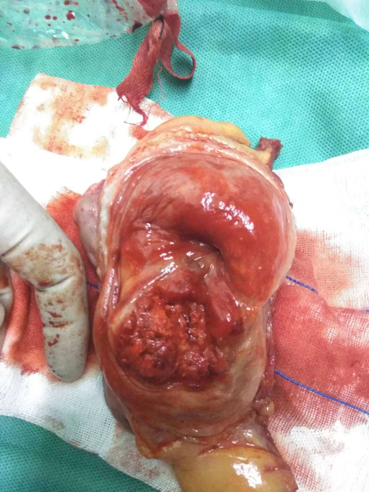 癌症补硒好吗(癌症补硒每天多少)-硒宝网