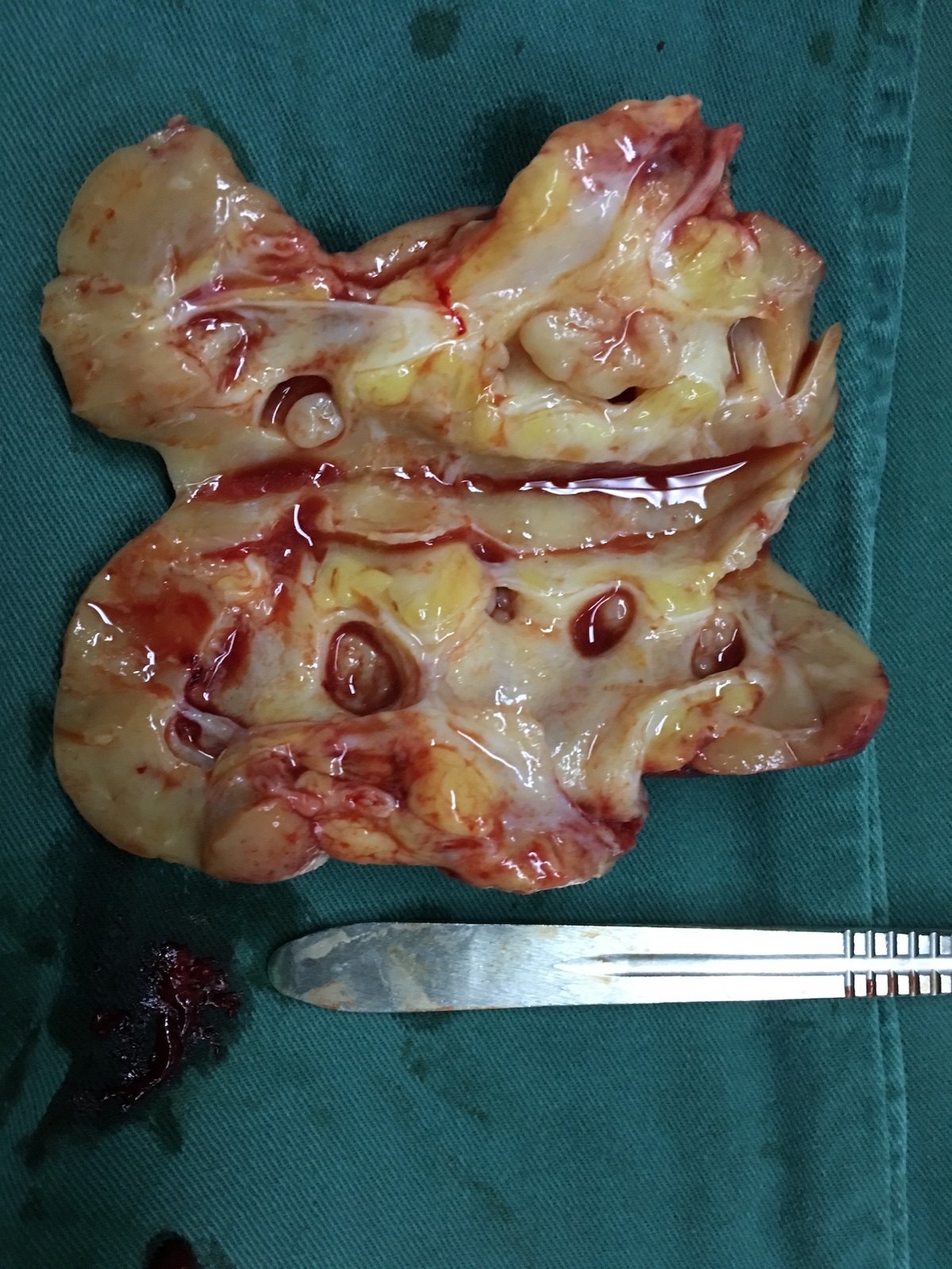 癌症补硒好吗(癌症补硒每天多少)-硒宝网