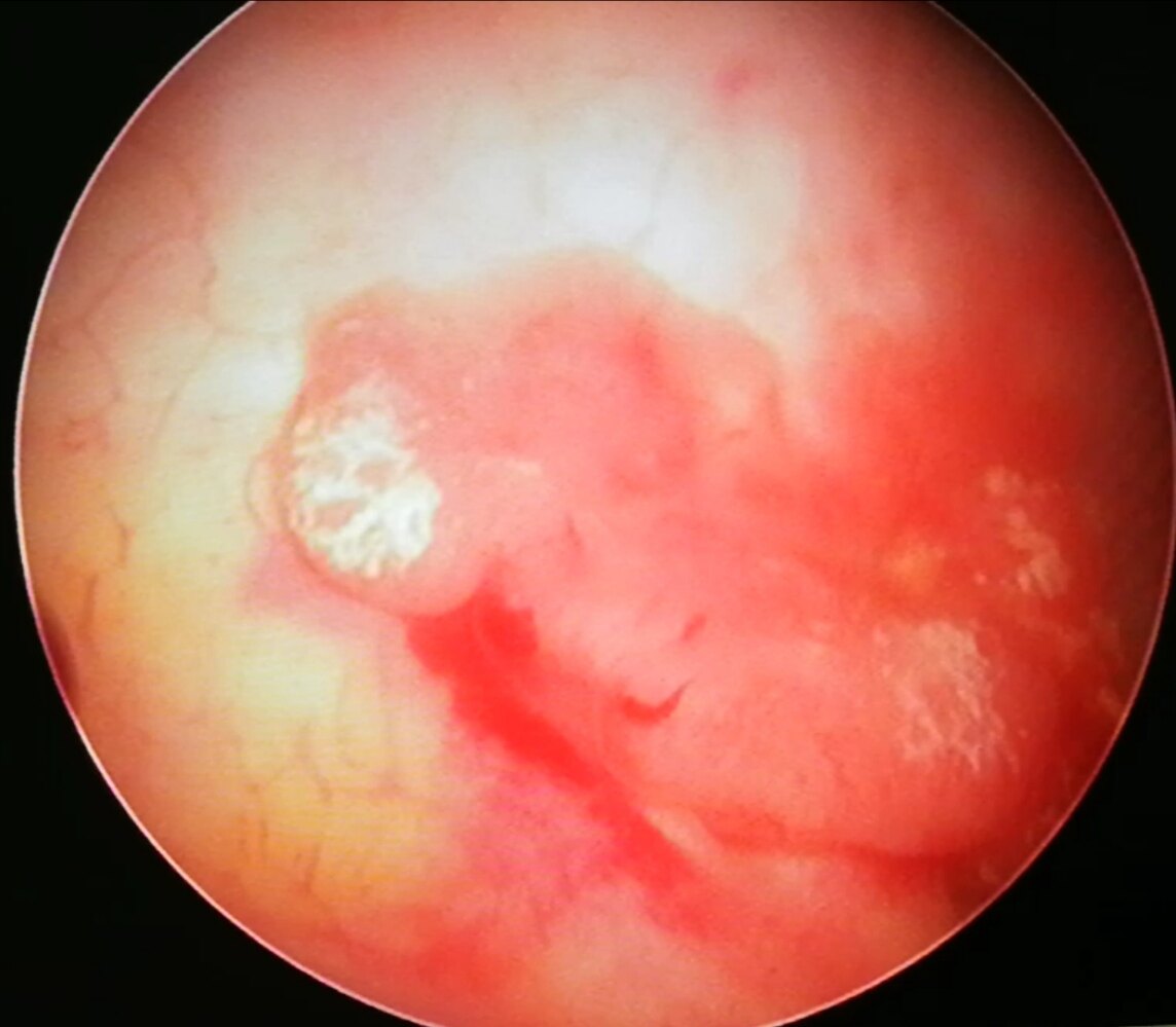 癌症补硒好吗(癌症补硒每天多少)-硒宝网