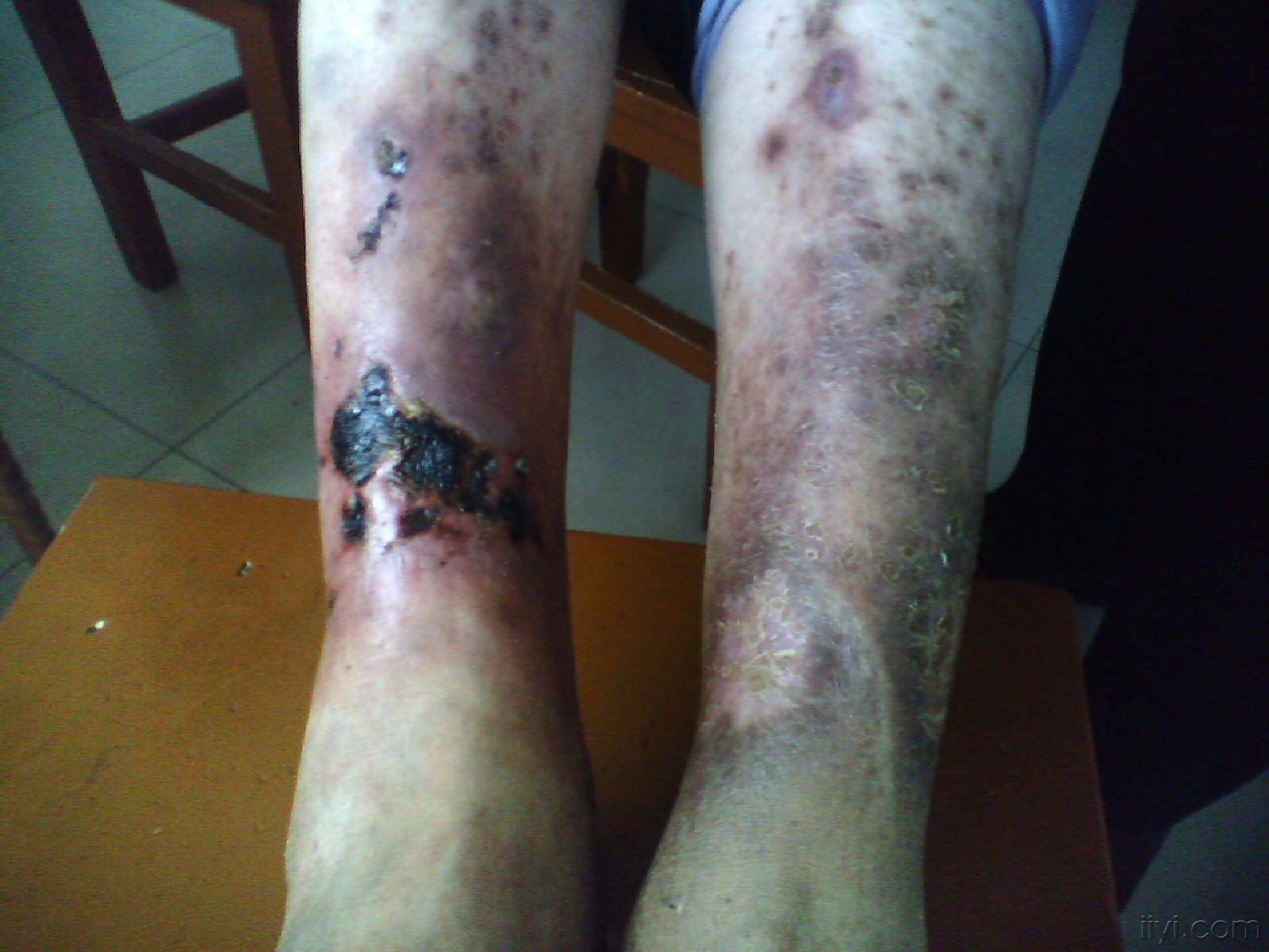 补硒正常反应(补硒后身体有哪些反应)-硒宝网