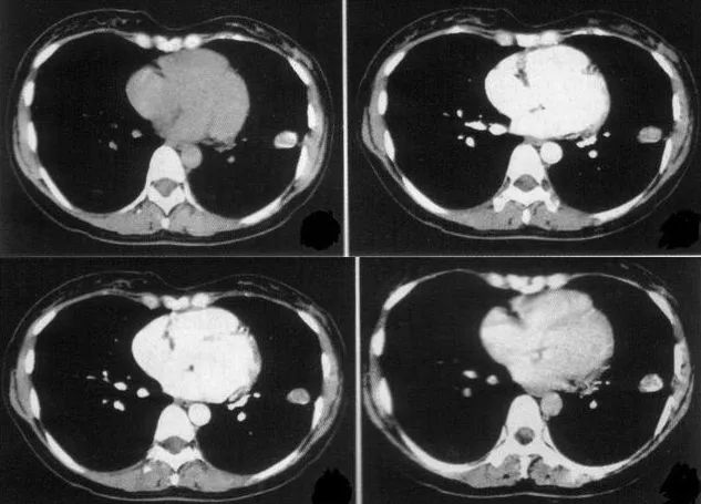 肺结节 补硒(肺结节吃硒有用吗)-硒宝网