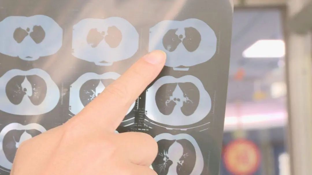 肺结节 补硒（硒对肺结节有作用吗）-硒宝网