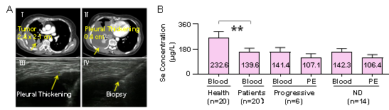 补硒肺癌几率(肺癌吃硒有作用吗)-硒宝网