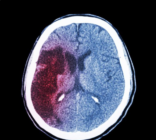 补硒脑梗案例(补硒脑梗案例)-硒宝网