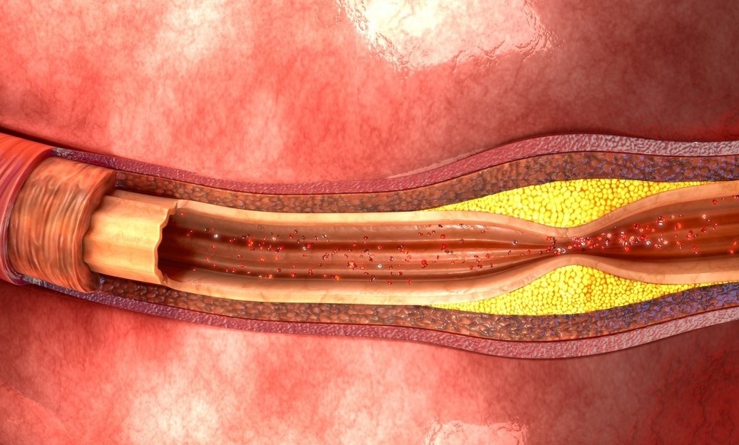 血脂稠能补硒（血脂稠能补硒）-硒宝网