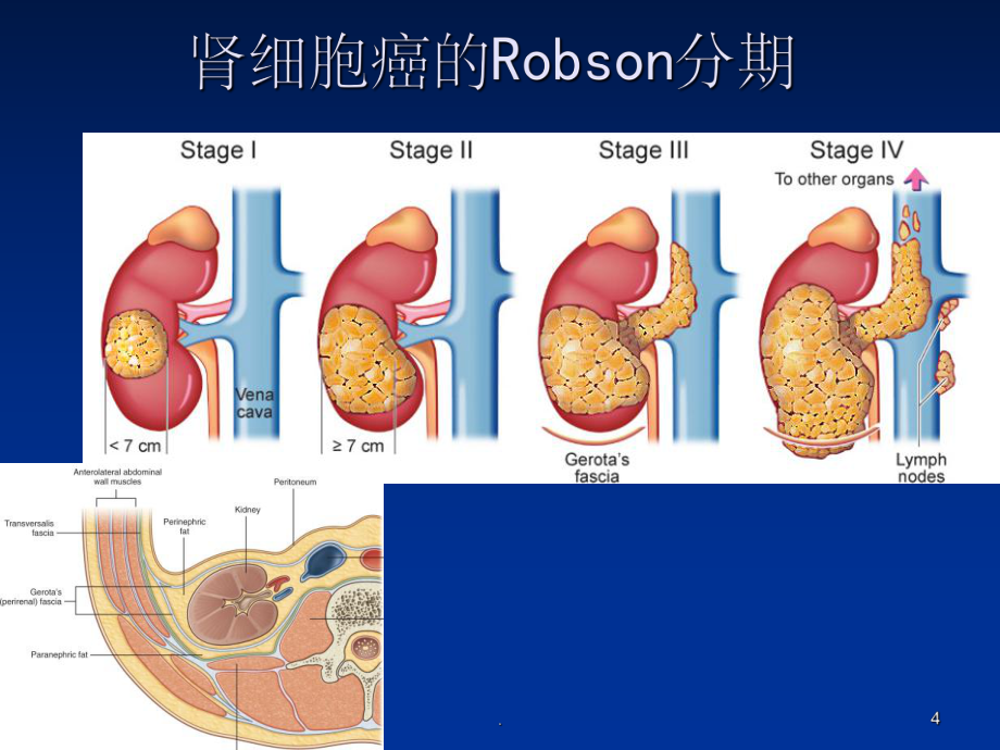 肾肿瘤补硒量（肾癌病人能吃硒吗）-硒宝网