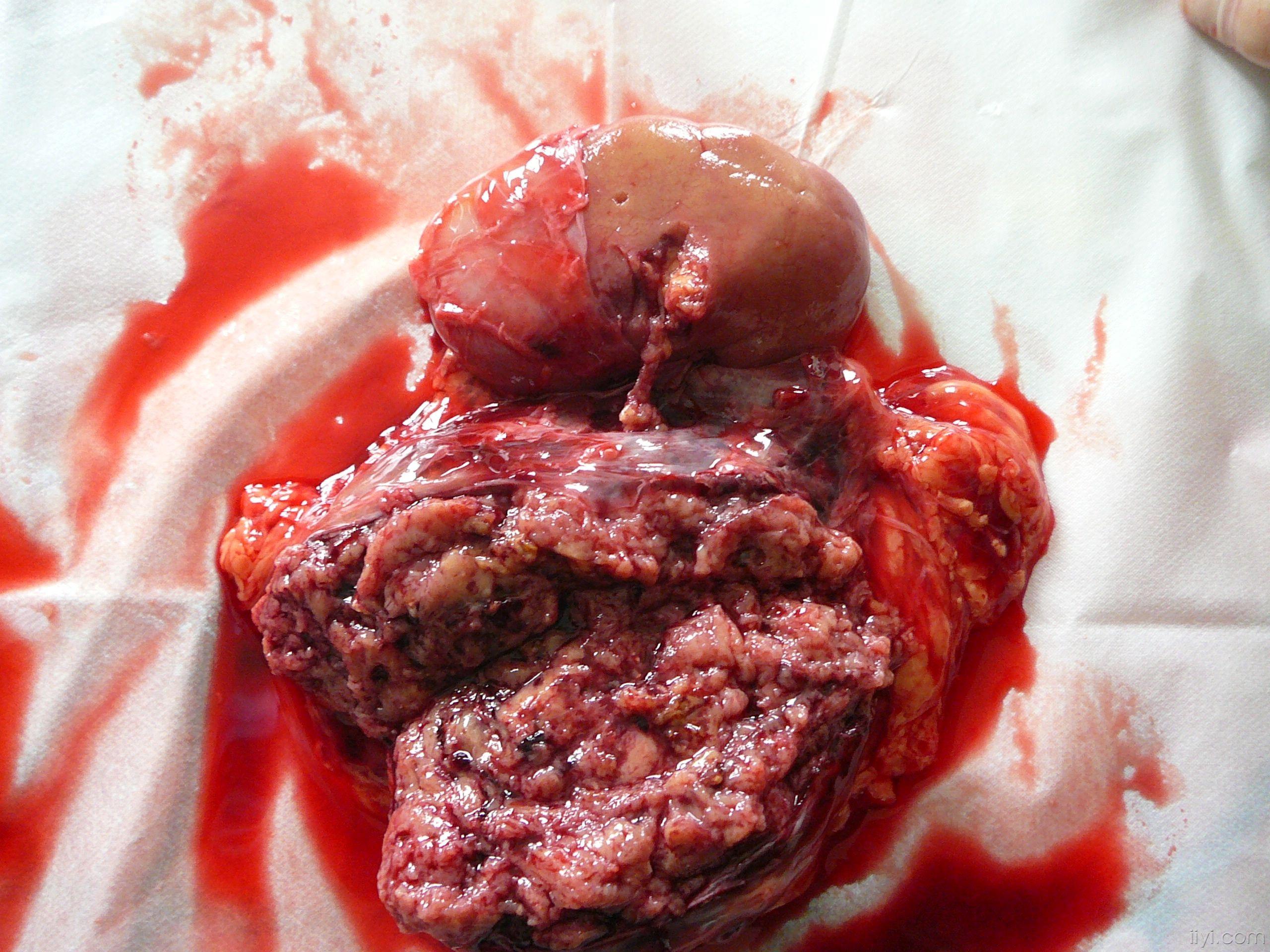 肾肿瘤补硒量（肾癌病人能吃硒吗）-硒宝网