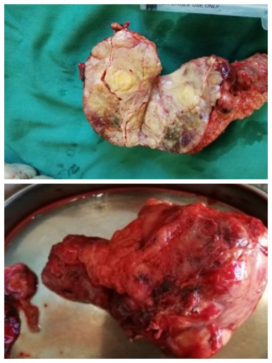 肾肿瘤补硒量(肿瘤病人硒的用量)-硒宝网