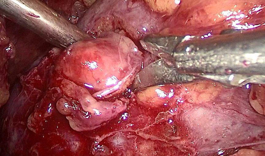 肾肿瘤补硒量(肿瘤病人硒的用量)-硒宝网