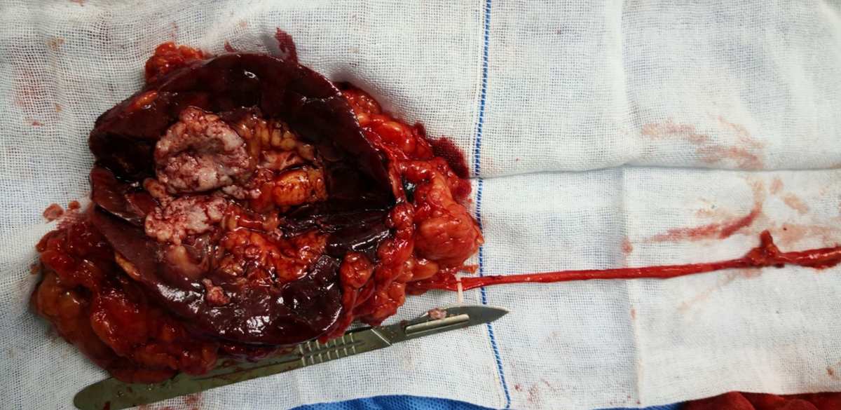 肾肿瘤补硒量(肿瘤病人硒的用量)-硒宝网