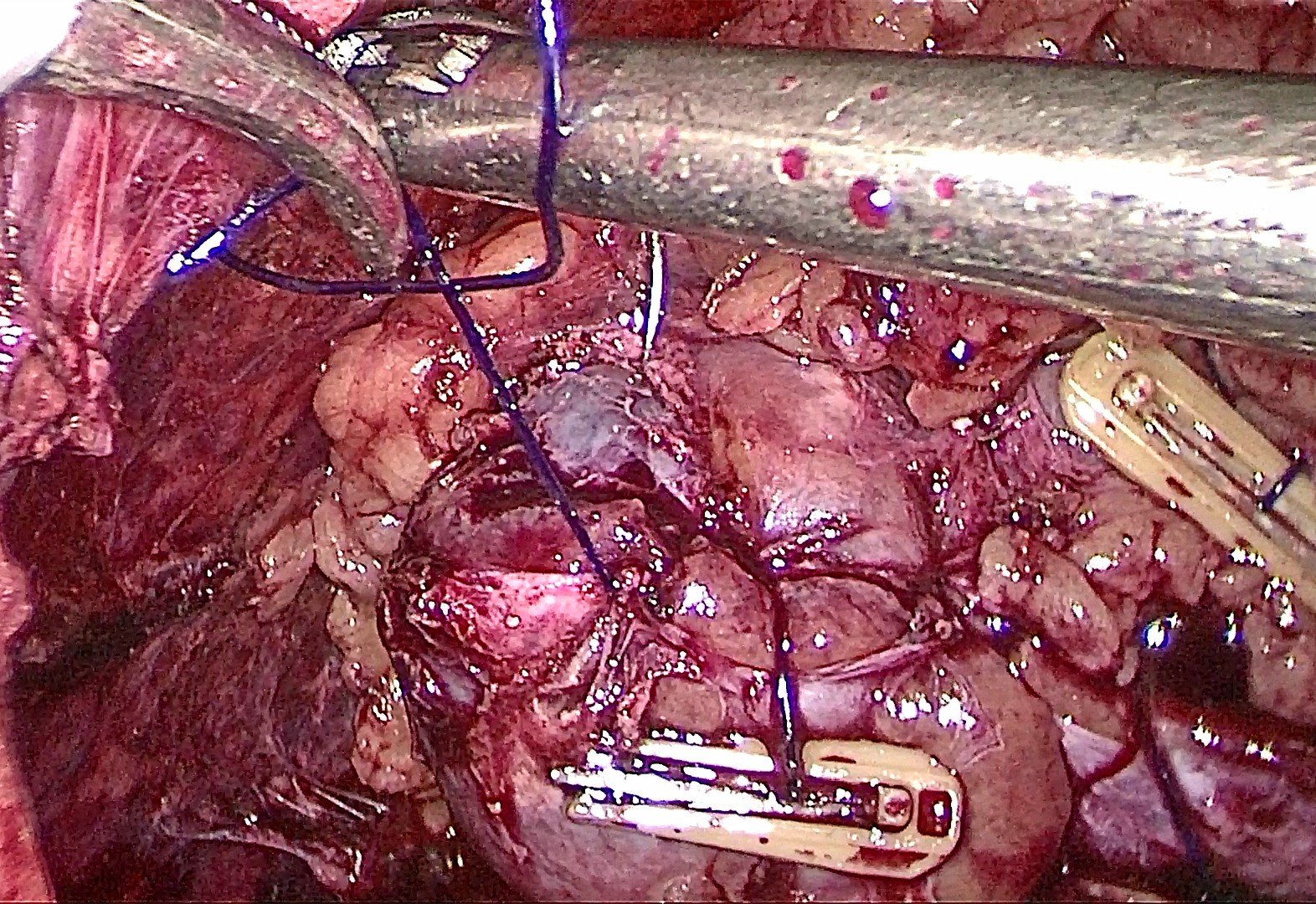 肾肿瘤补硒量(肿瘤病人硒的用量)-硒宝网