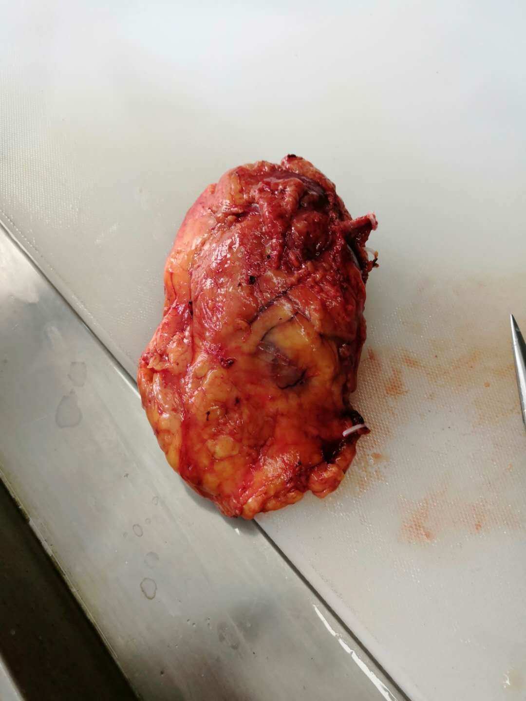 肾肿瘤补硒量(肿瘤病人硒的用量)-硒宝网