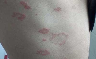 补硒皮肤过敏(过敏补皮肤硒可以吗)-硒宝网