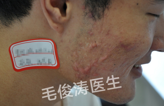 补硒治下巴痘(补硒长痘痘)-硒宝网