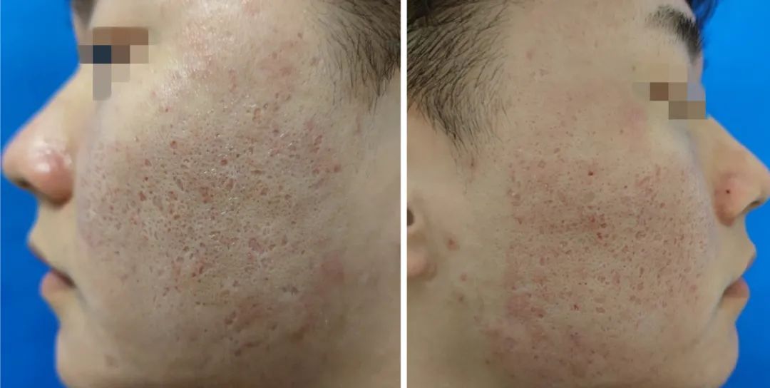 补硒治下巴痘(补硒长痘痘)-硒宝网