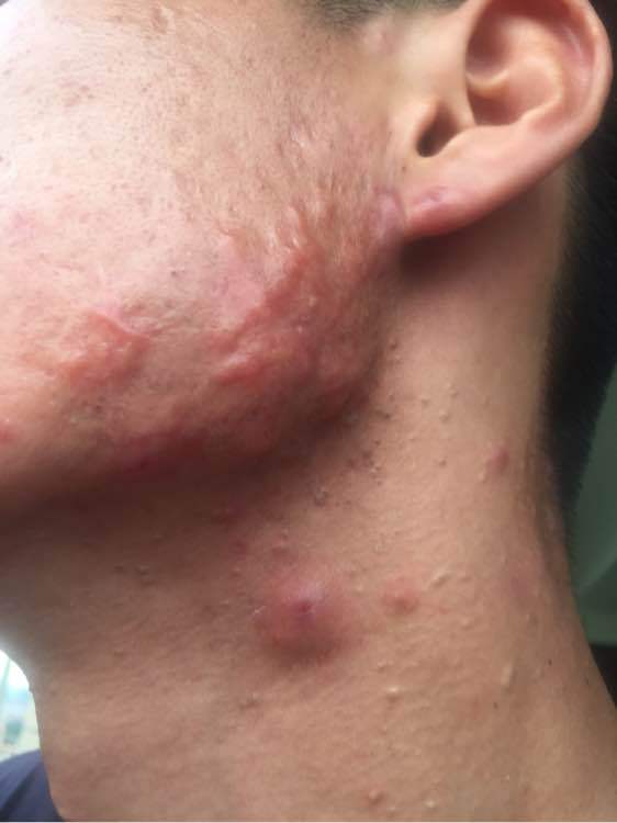 补硒治下巴痘(补硒长痘痘)-硒宝网