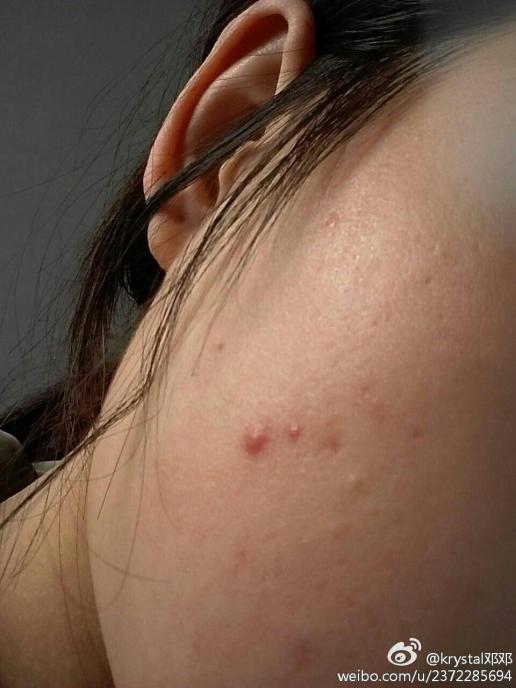 补硒治下巴痘（下巴长痘吃维生素b还是c）-硒宝网