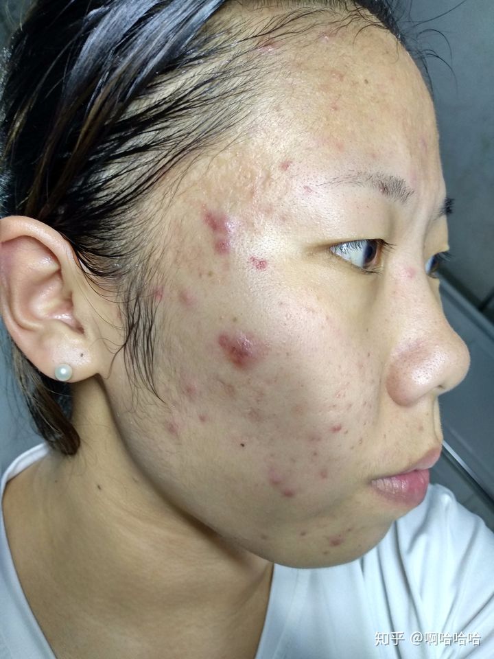 补硒治下巴痘（下巴长痘吃维生素b还是c）-硒宝网