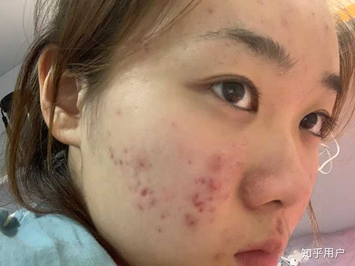 补硒治下巴痘（下巴长痘吃维生素b还是c）-硒宝网